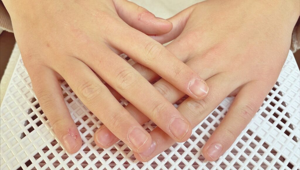 La ricostruzione in gel modifica strutturalmente l’unghia